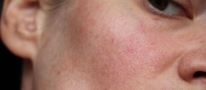 Close-up do rosto com manchas de melasma e pele sensível na bochecha, representando as alterações cutâneas comuns durante a gravidez.
