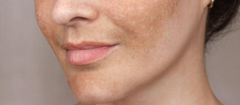 Rosto de mulher com manchas escuras na pele, características do melasma, visíveis nas bochechas, nariz e região do buço.