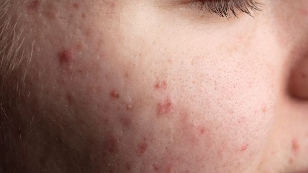 Foto do rosto de um jovem com cravos e espinhas que pode tratá-las com ácido para acne.