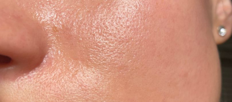 Close-up da pele do rosto de uma mulher, mostrando a região da bochecha e do nariz com aspecto brilhante e poros visíveis, sinais característicos da oleosidade da pele.