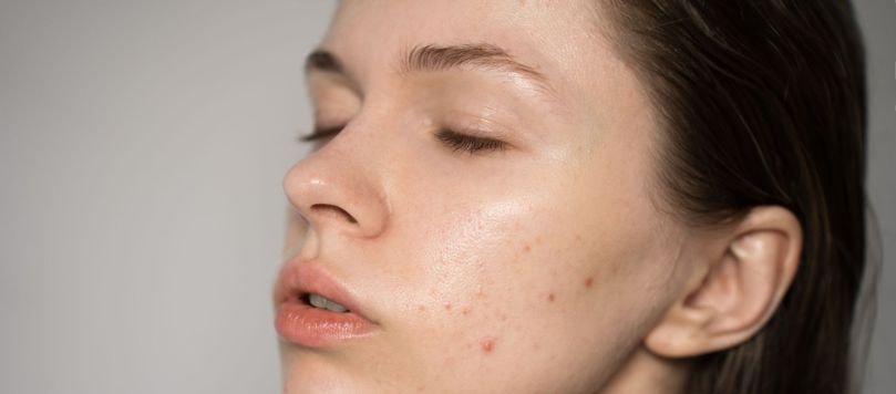 Mulher jovem de perfil com olhos fechados exibe pele com espinhas no rosto, representando os cuidados e tratamentos para pele acneica.