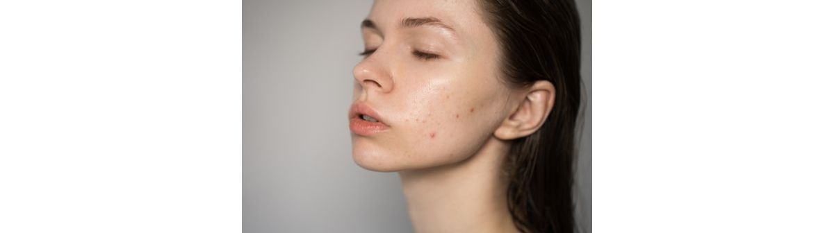 Foto da pele facial de uma mulher com poros dilatados no rosto que deve utilizar produtos específicos para pele oleosa.