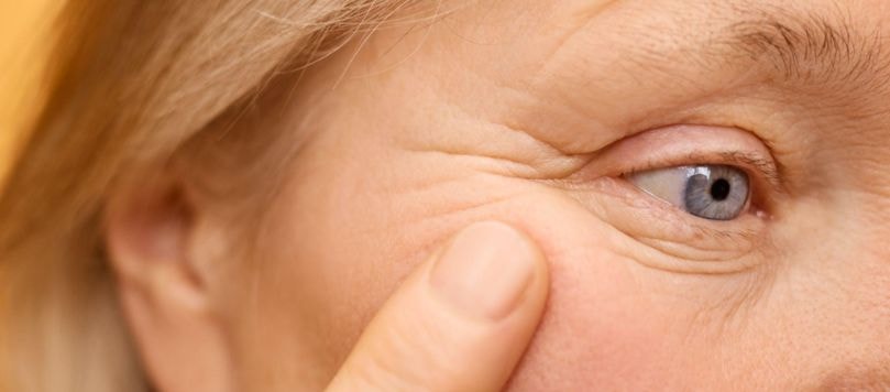 Close-up do rosto de uma mulher madura com rugas ao redor dos olhos. Ela aponta com o dedo para as linhas de expressão na região periorbital.
