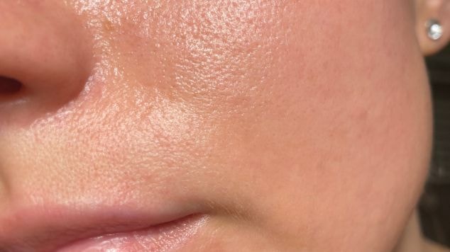 Foto do rosto de uma mulher com a pele oleosa e com poros dilatados que precisa de uma rotina de skincare para “fechar” os poros dilatados.