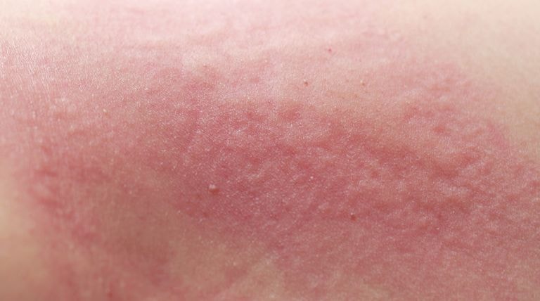 Foto de detalhes da pele sensível com vermelhidão, erupções e irritação