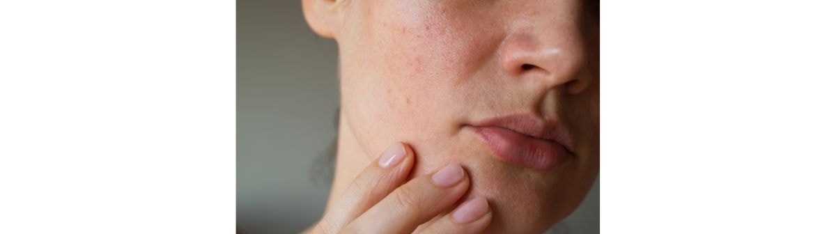 Rosto de uma mulher com a pele sensível que necessita de um hidratante específico para pele sensível.