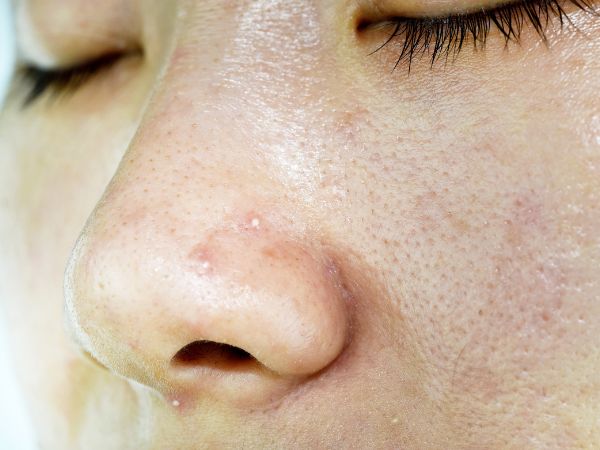 Jovem com a pele oleosa com cravos e espinhas, tipo de pele que se beneficia do uso de uma água micelar.