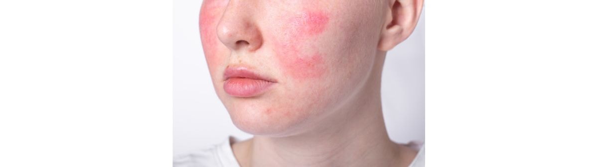 Pele do rosto de uma mulher que necessita de sabonete facial para pele sensível