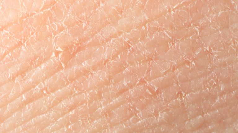 Foco em pele sensível com sinais de desidratação e ressecamento