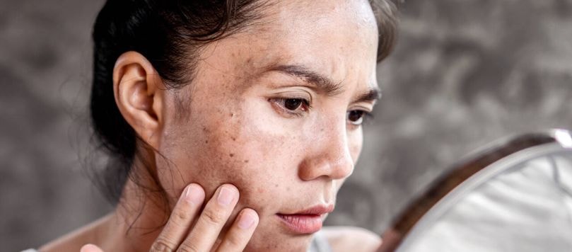 Mulher avalia sua pele com manchas no espelho, causadas pela exposição à luz azul e radiação solar.