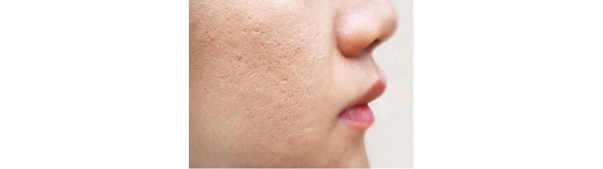 Cicatriz de acne: veja como tratar