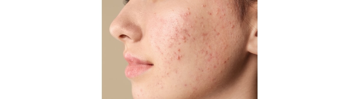 Tipos de acne: dermatologista explica cada uma