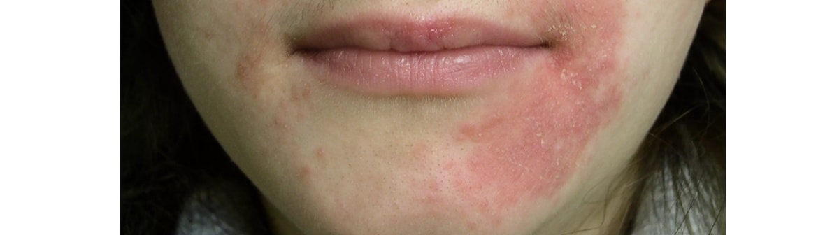 Pessoa caucasiana com dermatite na região esquerda do rosto, com foco na boca e no queixo.